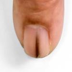 If this appears under your nail, it