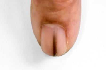 If this appears under your nail, it