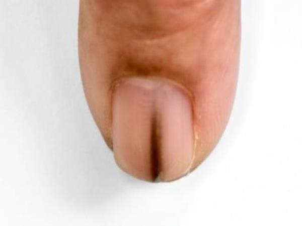 If this appears under your nail, it