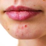 Which food causes acne?