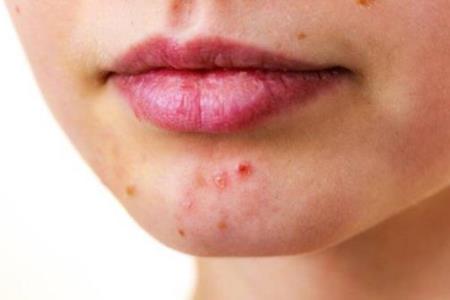 Which food causes acne?