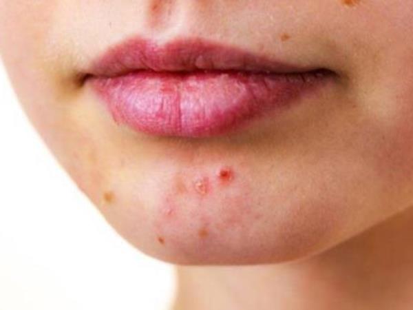 Which food causes acne?